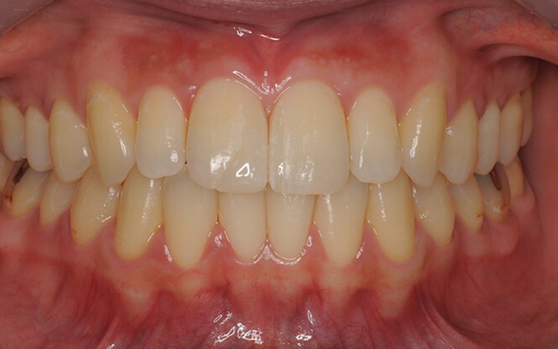 ラミネートベニア症例 治療後