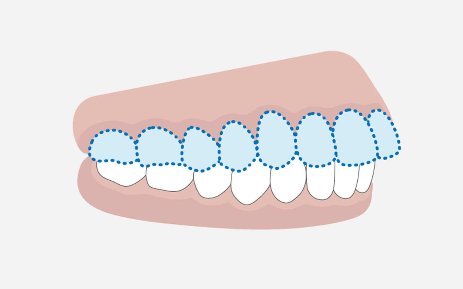 オールセラミック